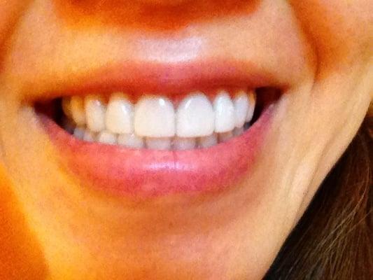 Results after wisdom tooth extraction, braces because of an underbite and then Lumineers veneers to complete! :)