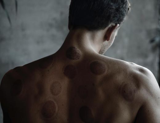Restore Qi and balance the body with acupuncture supported by cupping, moxibustion, and ear seeding.