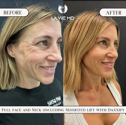 Full Face and Neck (Including Nefertiti) Lift With Daxxify