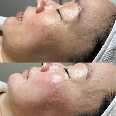 Superjection treatment (Retinoid)