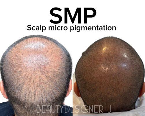 Before & after SMP treatment!!