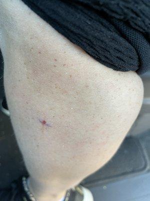 The broken skin from a dog bite