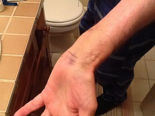 Fractured wrist being treated by Dr. Birkbeck
