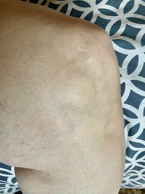 knee surgery to remove a tumor