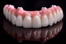 Fixed Implant dentures