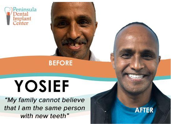 Top and Bottom Fixed Denture