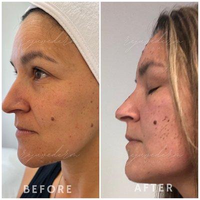 Before and one week after a plasma fibroblast full face lift. Results to continue improving for 120 days.