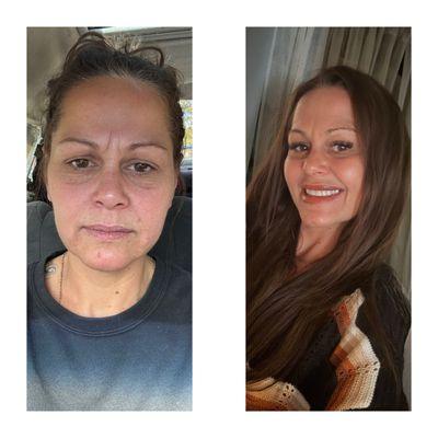 Both photos no makeup   Lashes plus  Botox throughout and lip injections  My Hair is a halo couture hair piece!