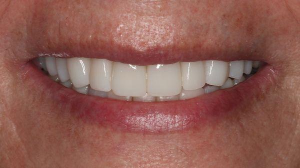 Ten porcelain veneers