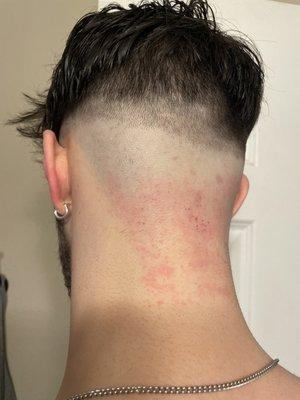 Bleeding and irritated