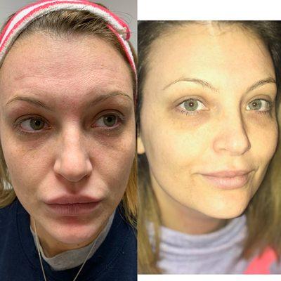 Laser Genesis Pre & Post