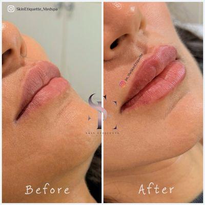 What 1 syringe looks like once swelling subsides and products settles