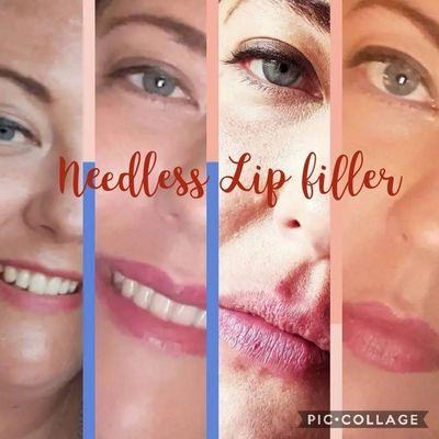 Needless Lip fillers by Tonya! A more natural approach injecting hylouronic acid with a high pressured gun.
