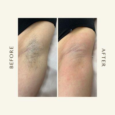 Underarm Wax | Before & After