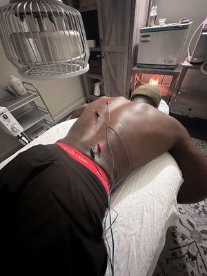 Electroacupuncture and cupping for low back and mid-thoracic injury