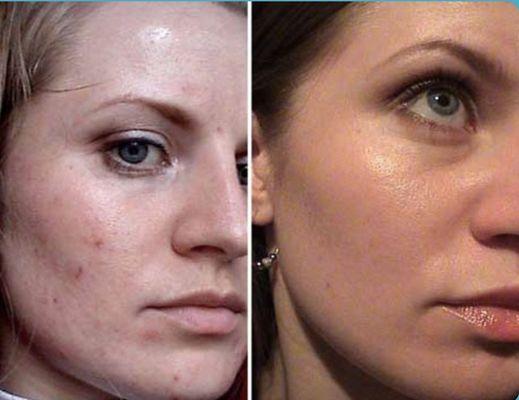 Before and After HydraFacial with LED plus home care.