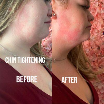 RF Chin Tightening