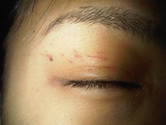 Scarring after 2 days. The scars lasted for 4 days and that was using Neosporin.