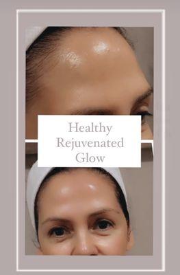Our after results from an Anti-Aging Treatment