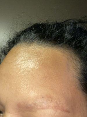 Horrible experience , I had to laser them off