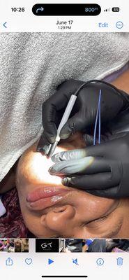 Delicate hair removal