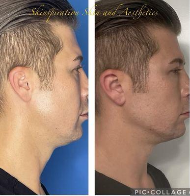 Jawline contouring with filler treatment