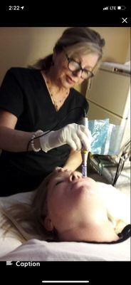 MicroNeedling is done with numbing cream for your comfort.