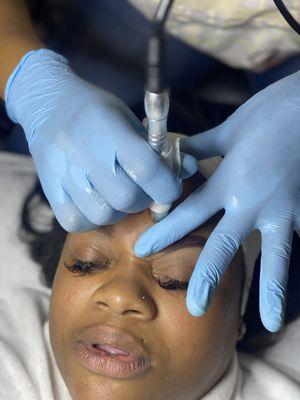 Microdermabrasion treatment.