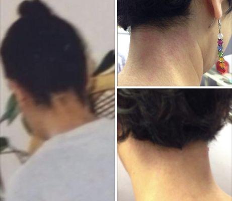 Before and after electrolysis hair line