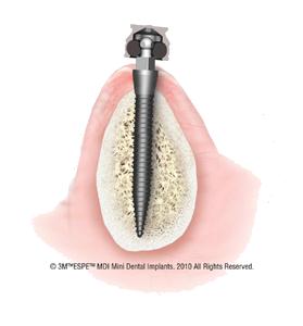 Now Placing Mini Dental Implants in Salisbury MD