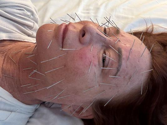 facial rejuvenation "facelift" acupuncture