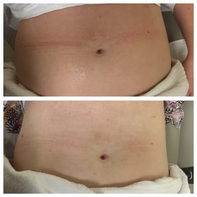 Great results from ultrasonic cavitation!