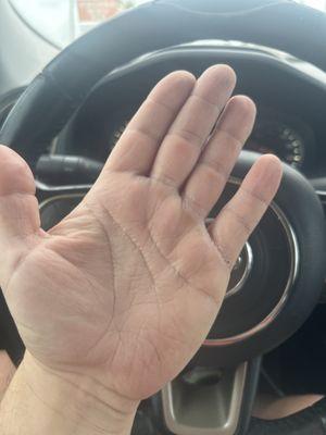 Dry itchy hands due to no lotion.