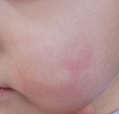 Fingerprint and broken capillaries on my child's cheek