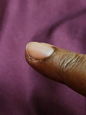 Swollen finger after having been cut - 24 hours later