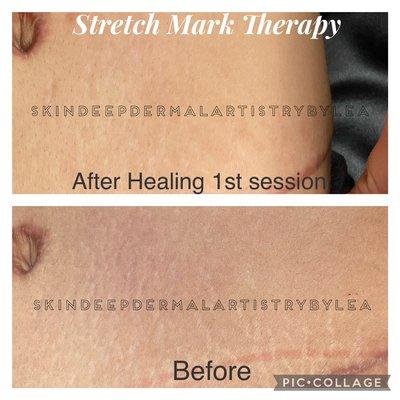 Stretch mark therapy