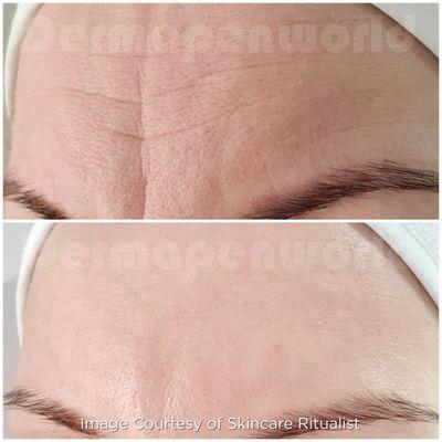 Medical microneedling with the premier Dermapen4.