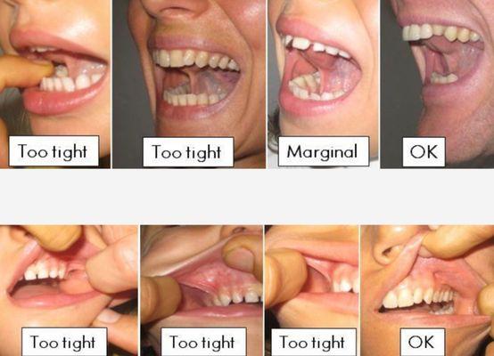 Orofacial Myofunctional Therapy of Colorado