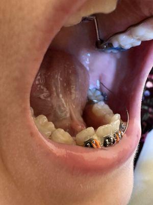 Broken wire and spring fall off and broken bracket