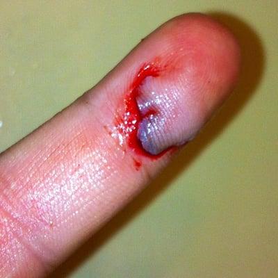 I cut my pinkie when the glass on a wine bottle chipped while opening it!