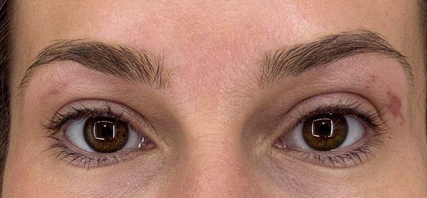 Burn on both eyebrows from waxing
