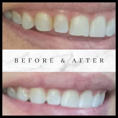 Client used whitening strips. Which can get into the crevices of our teeth or close to the gum line. We were able to even out the smile.