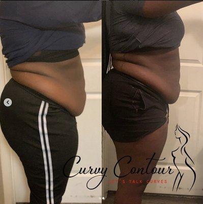 Body contouring Houston TX