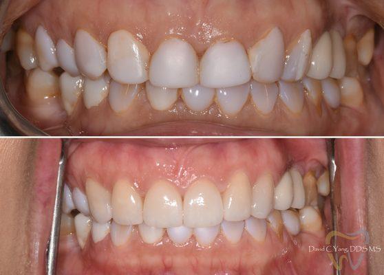Cosmetic veneers for a healthy new natural smile!