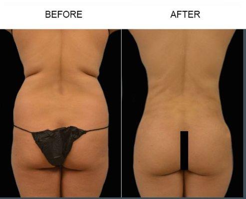 Tampa Liposuction by Bassin