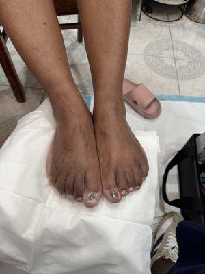 At home, the treatment requires trimming of the nails, addressing fungal infections, and removing calluses.