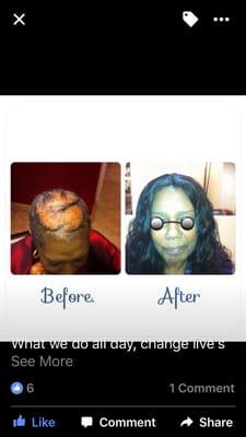 Full hair replacement