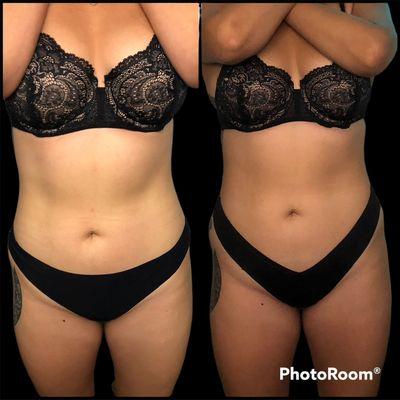 RF body sculpting. Lipo cavitation. Wood therapy