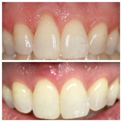 Gum repositioning for exposed roots from recession. This patient saw these results almost immediately and said she had no pain!