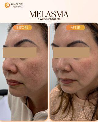 Melasma treatment